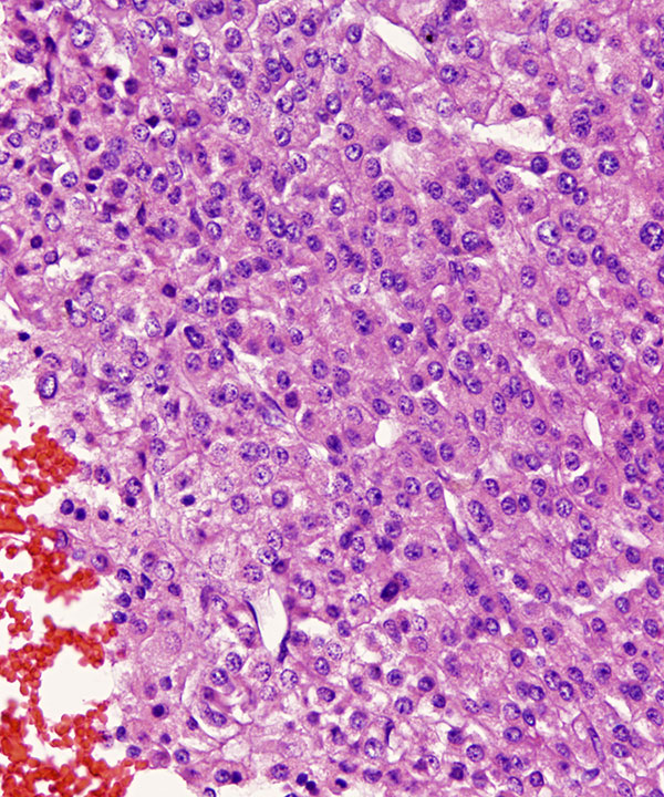 08 : Liver Hepatocellular Carcinoma