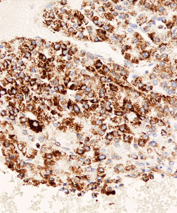 image showing 'Hepatocellular Carcinoma'