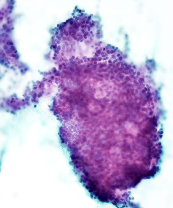 04 : Lung Adenoid Cystic Carcinoma