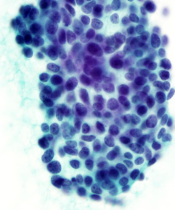 05 : Lung Adenoid Cystic Carcinoma