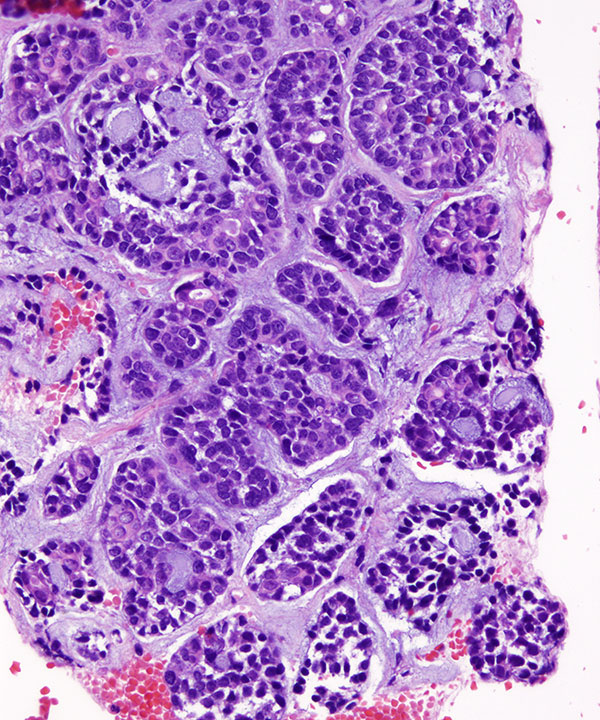 08 : Lung Adenoid Cystic Carcinoma