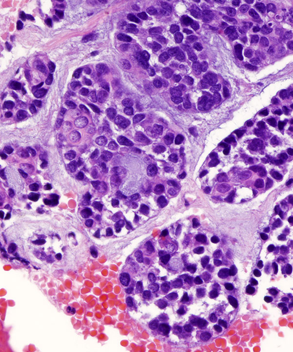 09 : Lung Adenoid Cystic Carcinoma