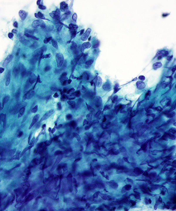 10 :  Lung Granulomatous Inflammation