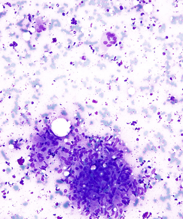 02 :  Lung Granulomatous Inflammation