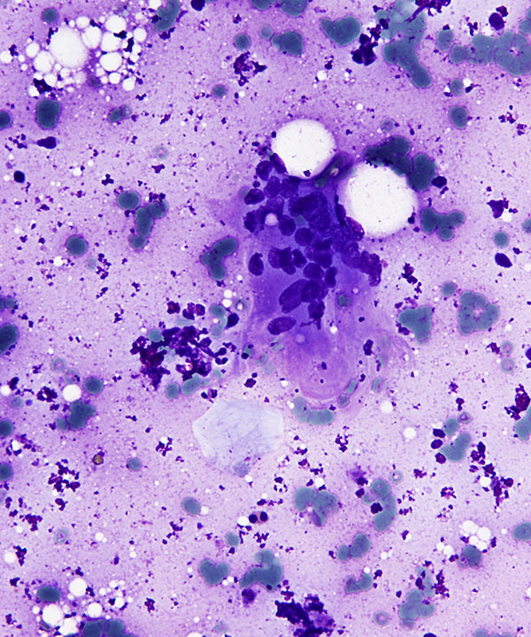 04 :  Lung Granulomatous Inflammation