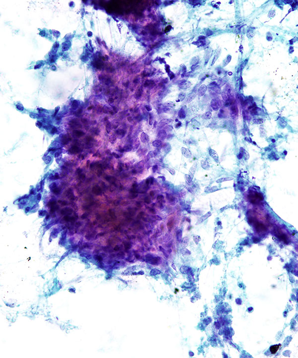 07 :  Lung Granulomatous Inflammation