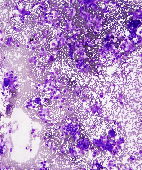 image showing 'Normal/Reactive Bronchial Cells'