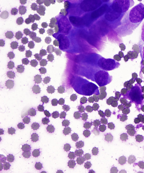 2 : LungNormanReactiveBronchialCells