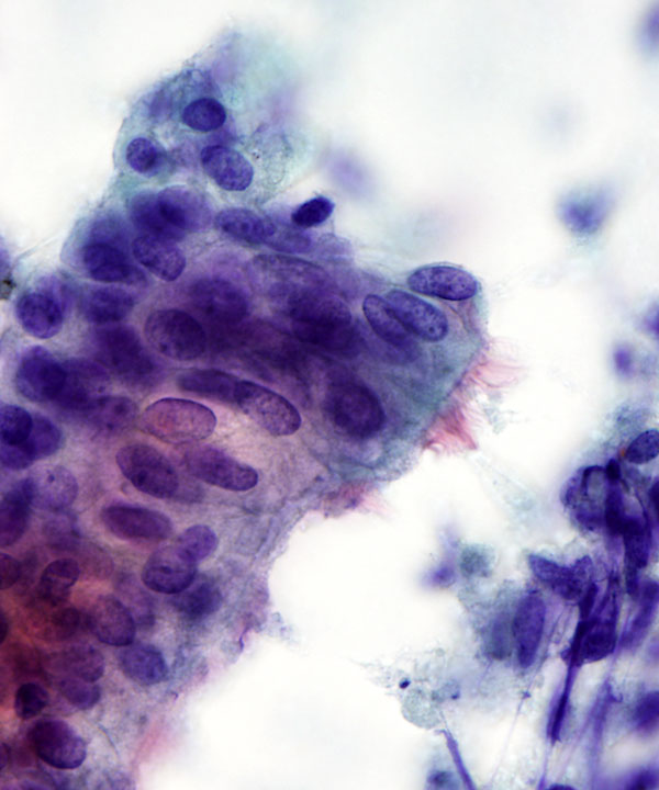 3 : LungNormanReactiveBronchialCells