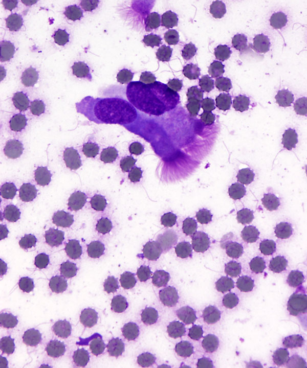 5 : LungNormanReactiveBronchialCells