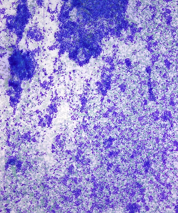 image showing 'Small Cell Carcinoma'