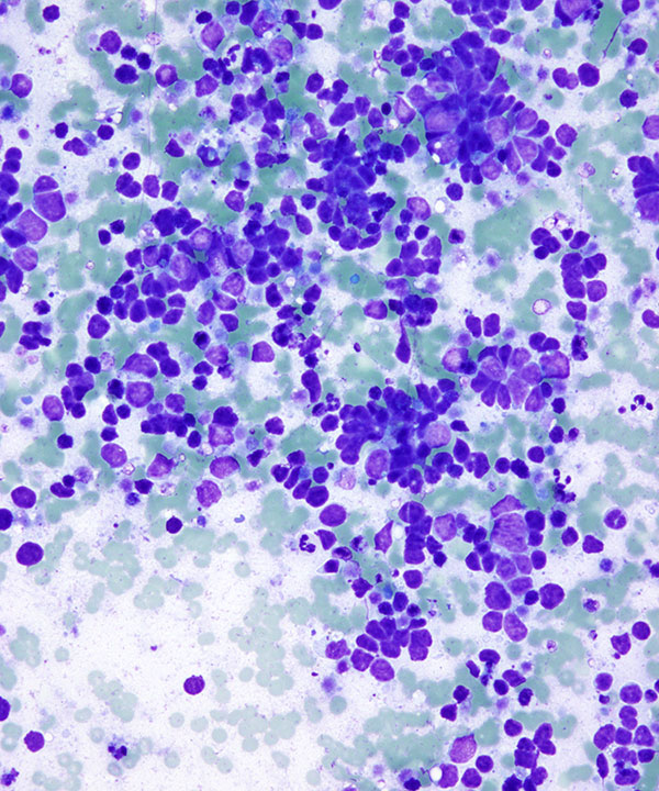 2 : Lung Small Cell Carcinoma