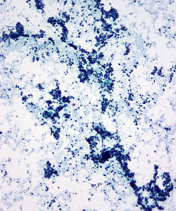 4 : Lung Small Cell Carcinoma