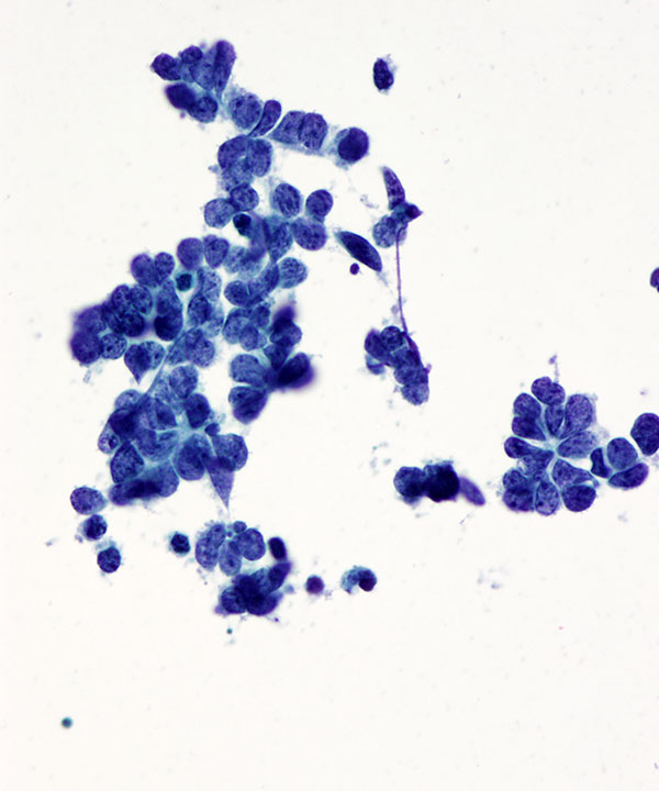 5 : Lung Small Cell Carcinoma