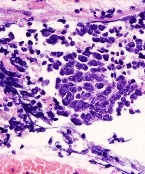 8 : Lung Small Cell Carcinoma