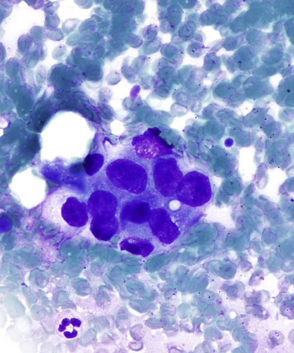 image showing 'Squamous Cell Carcinoma'
