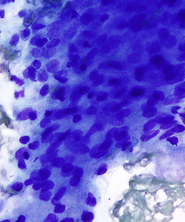 02 : Lung Squamous Cell Carcinoma