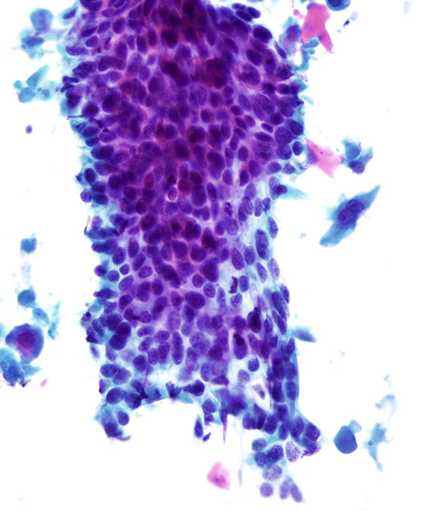03 : Lung Squamous Cell Carcinoma