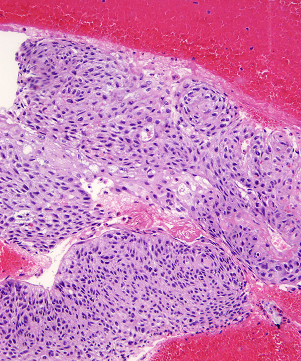 05 : Lung Squamous Cell Carcinoma