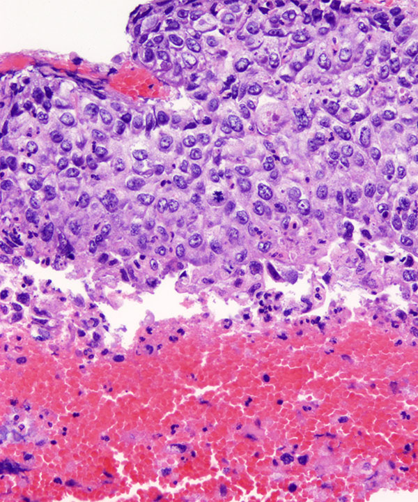 06 : Lung Squamous Cell Carcinoma