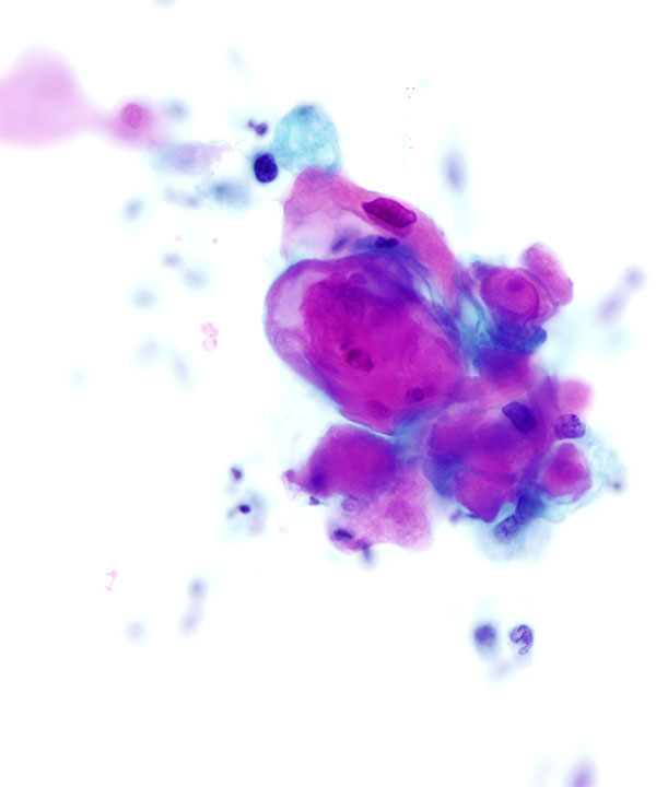 09 : Lung Squamous Cell Carcinoma