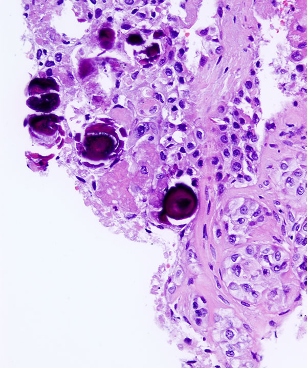 10 : Lung Squamous Cell Carcinoma