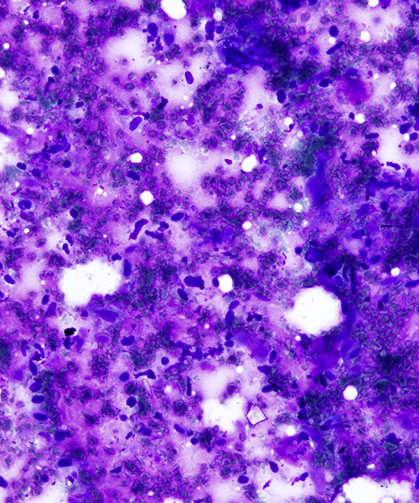11 : Lung Squamous Cell Carcinoma