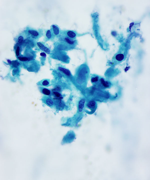 13 : Lung Squamous Cell Carcinoma