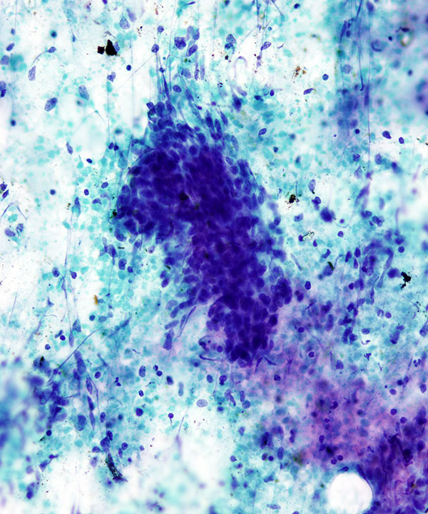 14 : Lung Squamous Cell Carcinoma