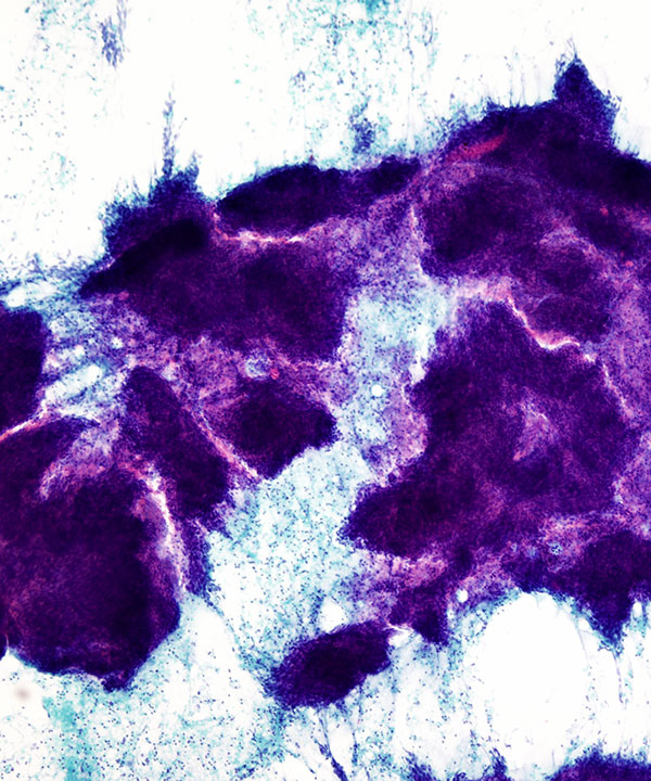 15 : Lung Squamous Cell Carcinoma