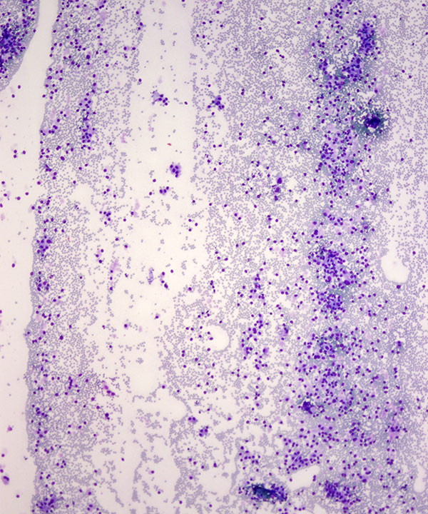 1 : Lung Neuroendocrine Tumor - Low Grade