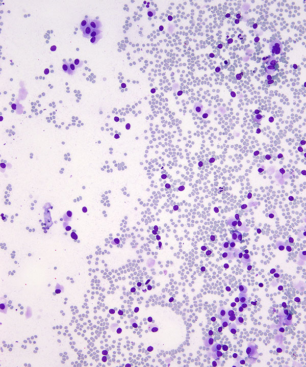 2 : Lung Neuroendocrine Tumor - Low Grade