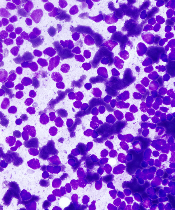 02 : Mediastinal Lymphoblastic Lymphoma