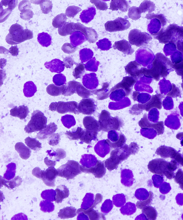 03 : Mediastinal Lymphoblastic Lymphoma