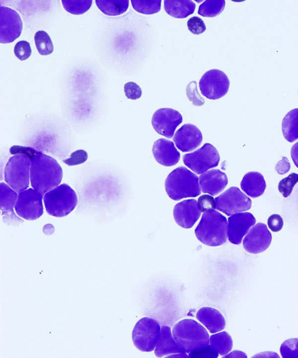 04 : Mediastinal Lymphoblastic Lymphoma