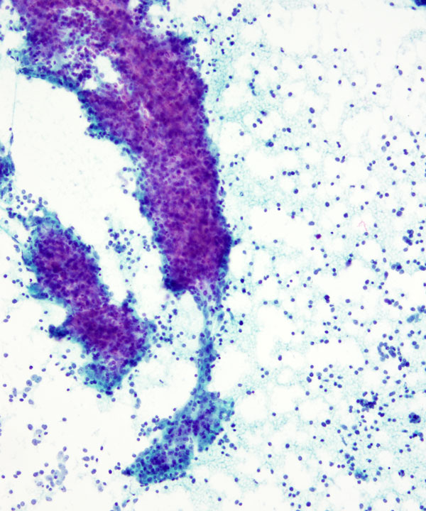 04 : Mediastinum Thymoma