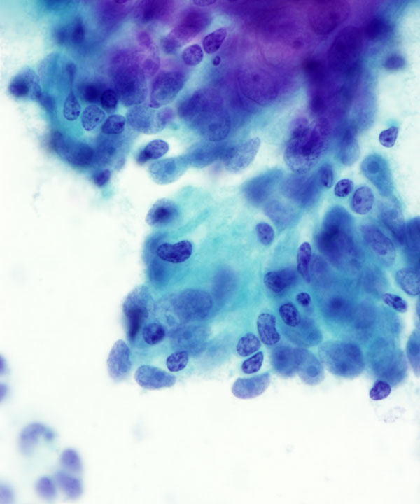 06 : Mediastinum Thymoma