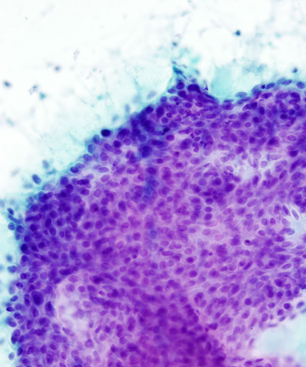 13 : Mediastinum Thymoma