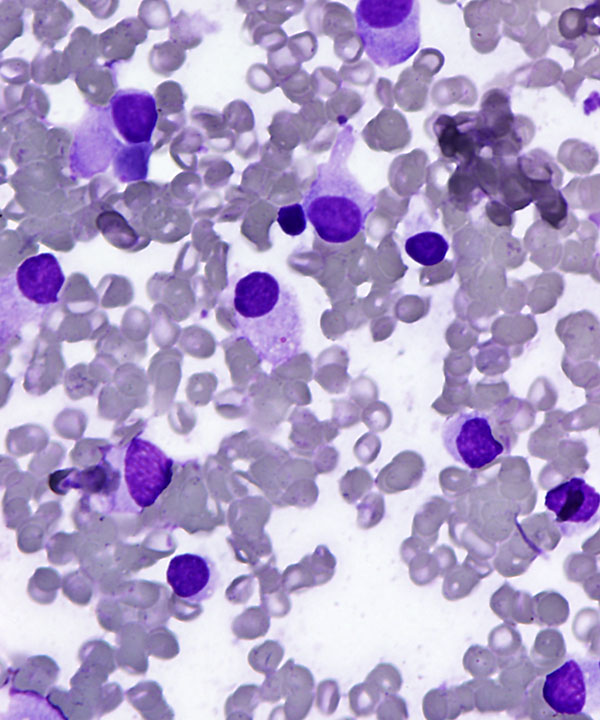 04 : Medullary Thyroid Carcinoma