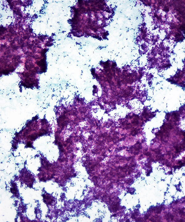 05 : Medullary Thyroid Carcinoma