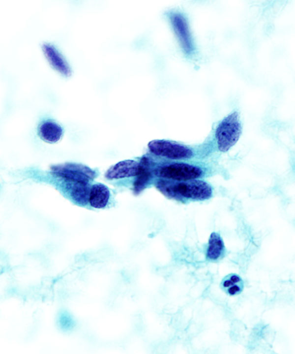 09 : Medullary Thyroid Carcinoma