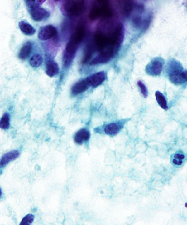 10 : Medullary Thyroid Carcinoma