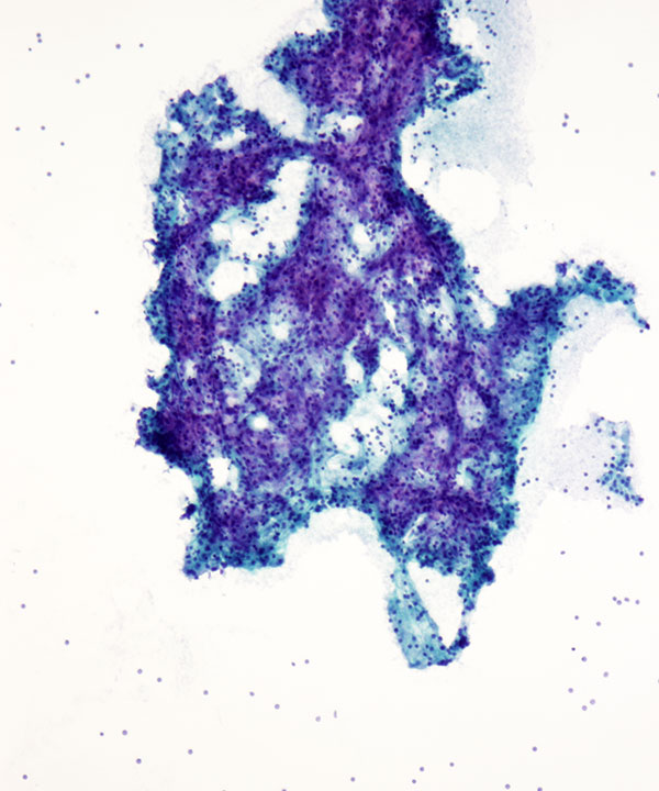 image showing 'Acinar Cell Carcinoma'