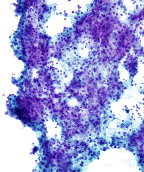 02 : Acinar Cell Carcinoma