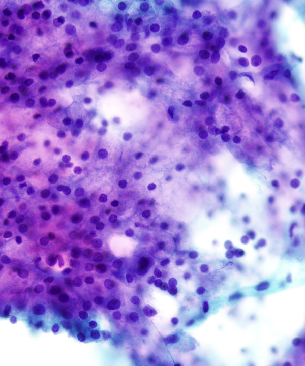 03 : Acinar Cell Carcinoma