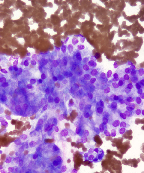 04 : Acinar Cell Carcinoma