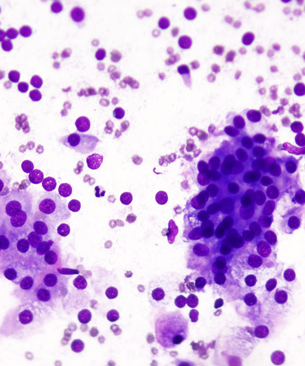 05 : Acinar Cell Carcinoma