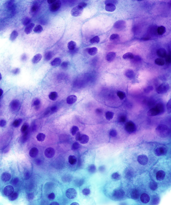 06 : Acinar Cell Carcinoma