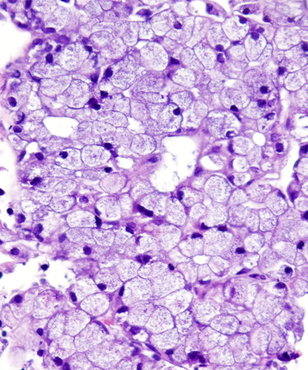 12 : Acinar Cell Carcinoma