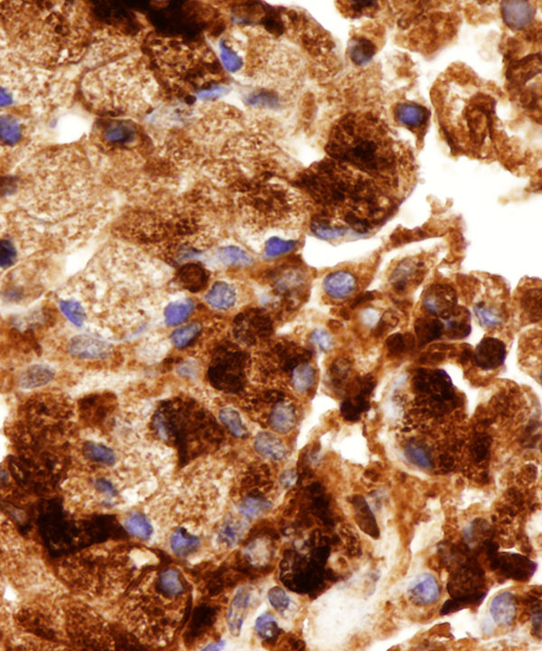 13 : Acinar Cell Carcinoma
